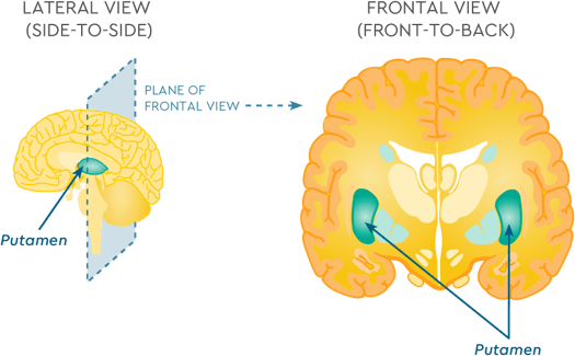 The role of the putamen in AADC deficiency